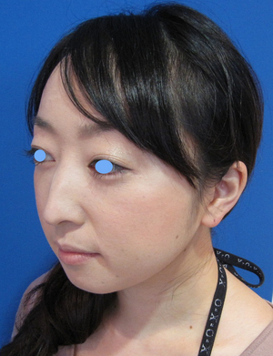 目の下のたるみ、目のくまでお悩みの方、切らずに完璧に解決します。TCB-R法　手術直後　症例写真